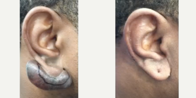 25-34 year old man treated with Scar Removal - 25-34 year old African American male came into the office presenting with a large keloid scar. The patient was treated with surgical removal of the keloid. After the ear was fully healed, we were able to re-pierce the ear with no additional growth of the keloid.