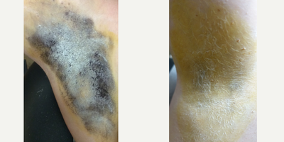 35-44 year old man treated with miraDry - Patient shown before and 2 weeks after mirDry treatment. An iodine solution is applied to the skin and allowed to air-dry. Once dry the area is dusted with cornstarch When sweat reaches the surface of the skin the starch and iodine combine causing a dramatic color change (yellow -&gt; dark blue) allowing sweat production to be actively visualized.