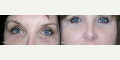 Woman treated with Latisse - Latisse