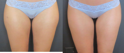 25-34 year old woman treated with UltraShape - UltraShape Power was used to smooth thighs and reduce fat.&nbsp;
