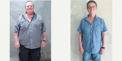 35-44 year old man treated with Gastric Balloon - Sleeve gastrectomy, also known as the gastric sleeve surgery, is a highly effective bariatric procedure that has gained popularity worldwide for individuals struggling with obesity and seeking a permanent weight loss solution. This procedure involves removing approximately 80% of the stomach, leaving a tube-shaped stomach about the size of a banana. The result is a significant reduction in the amount of food that can be consumed at one time, helping patients achieve and maintain substantial weight loss.