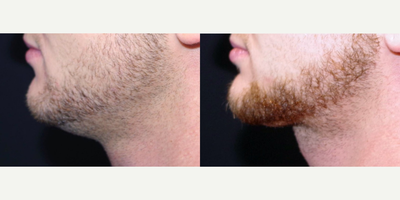 18-24 year old man treated with CoolSculpting to Chin; 2 months post-op - 24 year old male received one CoolMini treatment to the chin; photos depict the patient's results at 2 months post-op.