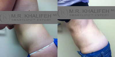 Woman treated with Liposuction - Woman treated with Liposuction