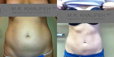 Woman treated with Liposuction - Woman treated with Liposuction