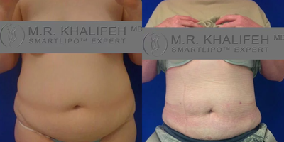 Woman treated with Gynecomastia Surgery - Woman treated with Gynecomastia Surgery