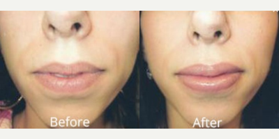 25-34 year old woman treated with Lip Implants - Dr. Deboni's mid-20s patient came to see him for a lip augmentation. She loves her lips!