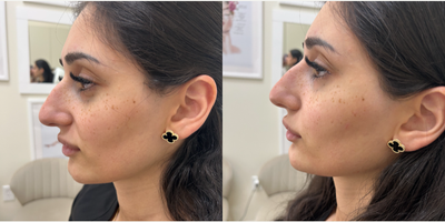 18-24 year old woman treated with Restylane Contour, Restylane Defyne - Facial balancing. Cheek FillerChin FillerJowels