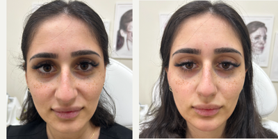 18-24 year old woman treated with Restylane Contour, Restylane Defyne - Facial balancing. Cheek FillerChin FillerJowels