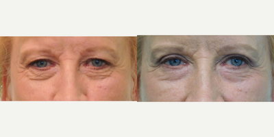 65-74 year old woman treated with CO2 Laser - This woman wished for improvement of her lower eyelid wrinkles. Under local anesthesia in our Center we performed one treatment of fractional CO2 laser treatment. She additionally had an upper blepharoplasty (eyelid lift) performed at the same time. There is noticeable improvement in the wrinkles, as well as some additional improvement in the lower eyelid bags.&nbsp;
