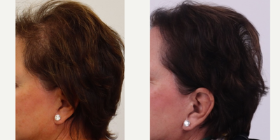55-64 year old woman treated with Hair Loss Treatment, PRP for Hair Loss - 5 months after 1 session of PRP with Exosomes.