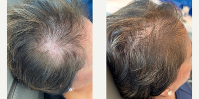 55-64 year old woman treated with Hair Loss Treatment, PRP for Hair Loss - 5 months after 1 session of PRP with Exosomes.