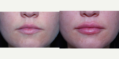 25-34 year old woman treated with Restylane - 27 year old female received Restylane filler to lips