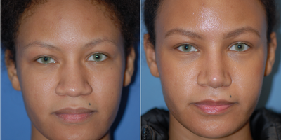 25-34 year old woman treated with African American Rhinoplasty - Nice thinning of the tip after rhinoplasty