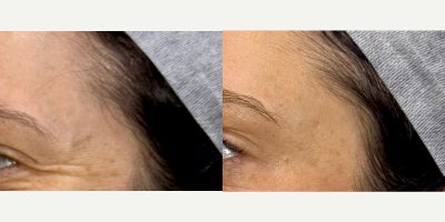 35-44 year old woman treated with Botox - Crows Feet Lines treated with 20 units of Botox