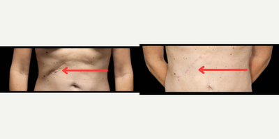 45-54 year old woman treated with Scar Removal Surgery - Say goodbye to that unsightly scar! Dr. Prucz recently had the pleasure of helping a lovely patient who was unhappy with the appearance of her abdominal scar after a liver surgery. Knowing his skills with cosmetic surgery she reached out and asked for help!The patient had a long, indented scar that was very visible. Dr. Prucz performed a scar revision procedure, which involved removing the old scar and creating a new, flatter scar that was more in line with the natural contours of the skin.The patient is thrilled with the results! If you have an unsightly scar that you're unhappy with, we encourage you to contact #DrRoniPrucz with #PhoenixPlasticSurgery to schedule a consultation. We can discuss your options and help you find the best way to improve the appearance of your scar.