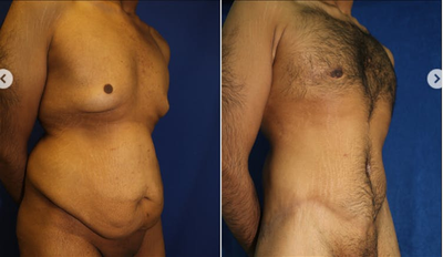 Man treated with Gynecomastia Surgery - Remove excess skin, fat and tissues from the breasts.