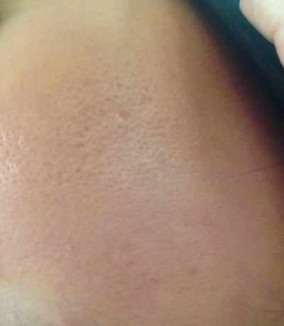 Best Treatment for Shallow Pitted Acne Scars? (photo ...