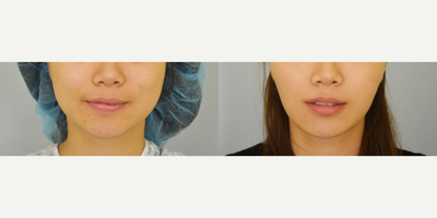 25-34 year old woman treated with Buccal Fat Removal - 25-34 year old woman treated with Buccal Fat Removal