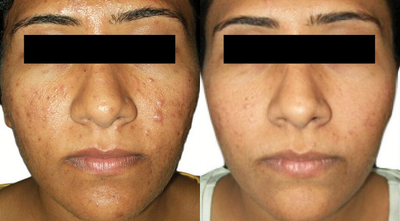 Venus Viva - Before and After 8 Treatments. &nbsp;Photos provided courtesy of Venus Concept, performed by Megha Joy Shah, MD.