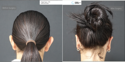 25-34 year old woman treated with Ear Surgery - Ear Surgery