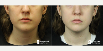 18-24 year old woman treated with AccuTite - This patient underwent Accutite to the face and neck define the jawline and chin. After photo is 3 months post-operation.