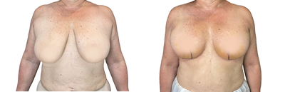 35-44 year old woman treated with Breast Reduction, Breast Reconstruction, Breast Lift - In this case a breast reduction with breast lift was performed. You can see the outcome of this surgical procedure typically manifests itself as fuller breasts with improved projection and natural-looking curves with enhanced volume in both the upper and middle parts of the breast area. Furthermore, because it was all done using your own body tissue. The final result is improved self-confidence due to aesthetically pleasing results achieved through minimal scarring in an L shape incision.