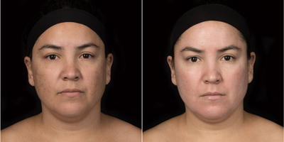 Cosmelan - Woman treated with Cosmelan.