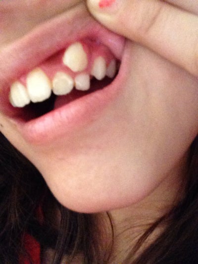 What do I do with my exposed canine tooth which is above my baby tooth ...