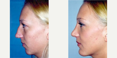 Woman treated with Rhinoplasty - Woman treated with Rhinoplasty and Chin Implant