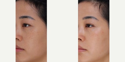 35-44 year old woman treated with BroadBand Light (BBL), Microneedling RF - 3 weeks after 1 session of BBL and RF Microneedling.