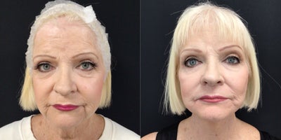 65-74 year old woman treated with Facelift, Chemical Peel - RHYTIDECTOMY VIA SMASECTOMY WITH LOWER LID, MIDFACE, AND PERIORAL PHENOL-CROTON PEEL.