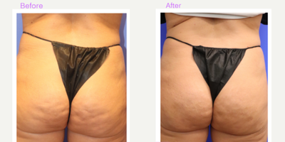 35-44 year old woman treated with Cellfina - 2 weeks after Cellfina