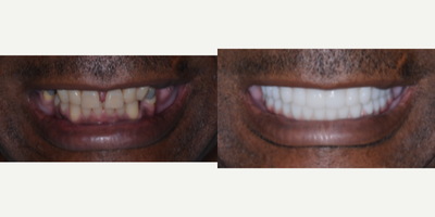 45-54 year old man treated with All On 4 Dental Implants - All-on-4 Dental Implants restored using Xircon Ultra- Ultimate