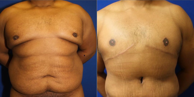 25-34 year old man treated with Male Tummy Tuck - This is a 34YO male who had lost a lot of weight with diet and extreme exercise. During the horizontal abdominoplasty, Dr. Katzen removed excess abdominal skin and fat and the rectus muscles were reapproximated. This took about 3hrs.