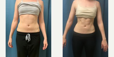 25-34 year old woman treated with Emsculpt - Emsculpt