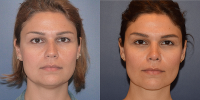35 years old female treated with rhinoplasty, buccal fat removal and vaser neck liposuction - 35 years old female, complaining about her nose, cheek fullness and stubborn fat on her neck. I performed rhinoplasty, buccal fat removal and vaser neck liposuction. She had deviation, hump and breathing problems as well. We got with rhinoplasty natural and fantastic result and fixed the airway. Buccal fat removal address the medial cheek fullness, via intraoral approach. Careful excision should be performed. Over excision may cause hollowing appearence. During Vaser neck liposuction means we use ultrasound energy to melt the fat while protecting surrounding tissues and helps to get better result than traditional liposuciton.