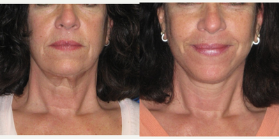 65-74 year old woman treated with Face and neck lift - She was c/o looking tired and old when she felt young and vibrant. She underwent a face and neck lift without general anesthesia. The procedure takes just under two hours.