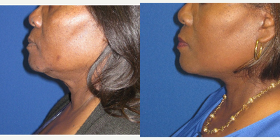55-64 year old woman treated with a Lower Face and Neck Lift - She was not happy with her loose neck and jawline. She did not like the way it looked in photos. She underwent a lower face and neck lift.