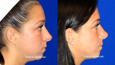 25 year old woman treated with Revision Rhinoplasty - A complex revision rhinoplasty was performed on this 25 year old woman who was extremely unhappy with her crooked rhinoplasty result performed by another surgeon. The patient's nose and septum were straightened using several surgical techniques including spreader grafting to the nasal dorsum. The result is a straight nose with a beautifully defined and symmetric nasal tip.