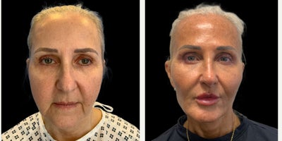 55-64 year old woman treated with Deep Plane Facelift, Facelift, Facial Fat Transfer, Eyelid Surgery, Lip Lift, Chin Implant - procedures:An extended deep plane faceliftDeep neckliftFat transfer to cheekschin implantLip liftBuccal fat removalLower blepharoplasty using transconjunctival fat repositioning