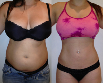 35-44 year old woman treated with Lipodissolve - Liposuction and lipodissolve to abdomen and flanks and back.