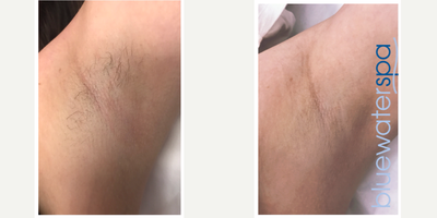35-44 year old woman treated with GentleLase - Laser hair removal of the underarms