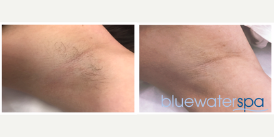 25-34 year old woman treated with GentleLase - Laser hair removal of the underarms