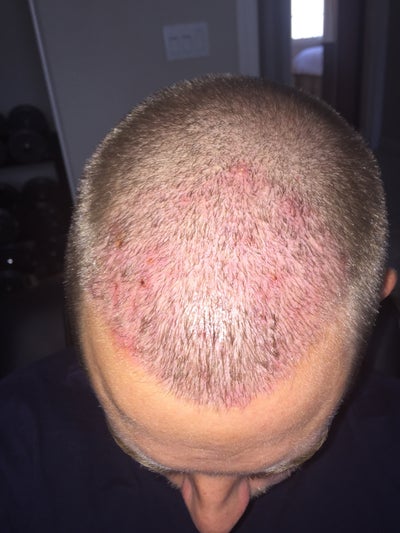 Will folliculitis 8 days post hair transplant effect graft growth ...