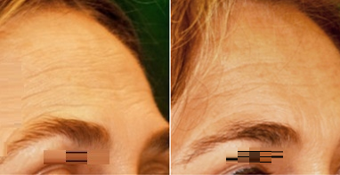 Woman treated with Pelleve - Woman treated with Pelleve