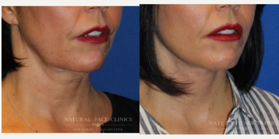 55-64 year old woman treated with Facelift, Chin Liposuction, Restylane - Patient had Facelift, submental liposuction, Restylane 1ml perioral.