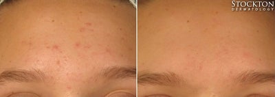 18-24 year old woman treated with LED Skin Treatment - Light-emitting diode (LED) therapy is a light-emitting unit placed over the area to be treated to reduce acne, pigment, fine lines and to combat the signs of aging. The plate is large enough to treat backs, chest and other large surface areas and can be used in conjunction with oxygen, microcurrent and lymphatic drainage.