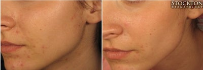 18-24 year old woman treated with LED Skin Treatment - Light-emitting diode (LED) therapy is a light-emitting unit placed over the area to be treated to reduce acne, pigment, fine lines and to combat the signs of aging. The plate is large enough to treat backs, chest and other large surface areas and can be used in conjunction with oxygen, microcurrent and lymphatic drainage.