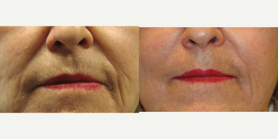 Bellafill for correction of nasolabial folds - This 65 year old patient's beautiful and natural appearing results were achieved using Bellafill (formerly called Artefill) in the nasolabial folds.