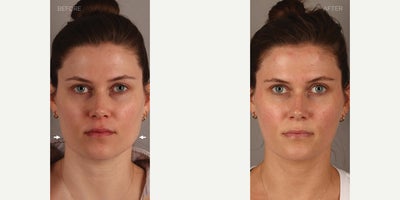 Non-Surgical Jawline Slimming (Botox to Masseters) - 31-year-old female who presented complaining of a square face secondary to masseter (chewing muscle) enlargement. She also complained of pain and tooth damage from grinding and clenching her teeth. She is shown 6 weeks after neurotoxin (Botox) treatment to these muscles, resulting in jawline slimming and a more heart-shaped face. She also has complete relief from her symptoms.